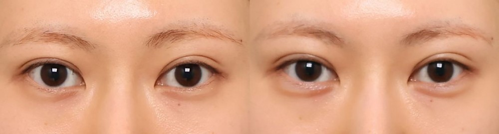 애교필러 정면 전후사진